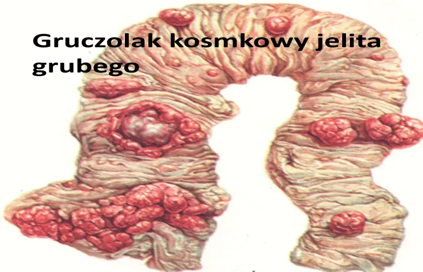 Gruczolak kosmkowy jelita grubego