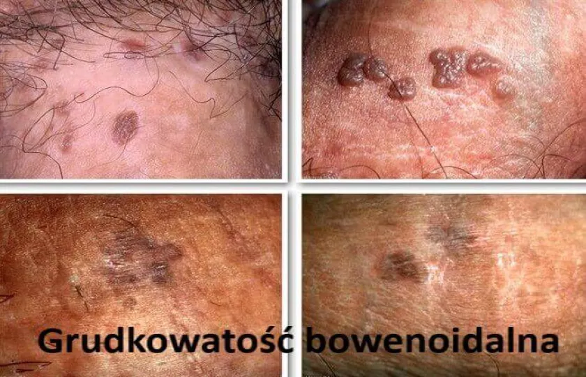Grudkowatość bowenoidalna 