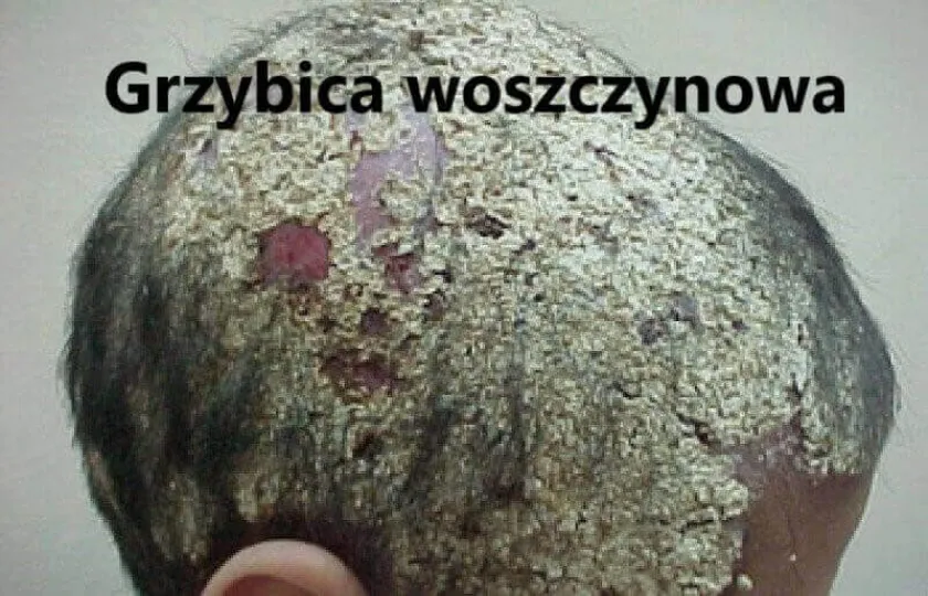 Grzybica woszczynowa