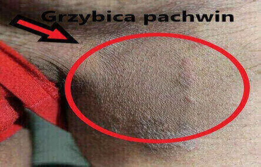 Grzybica pachwin 