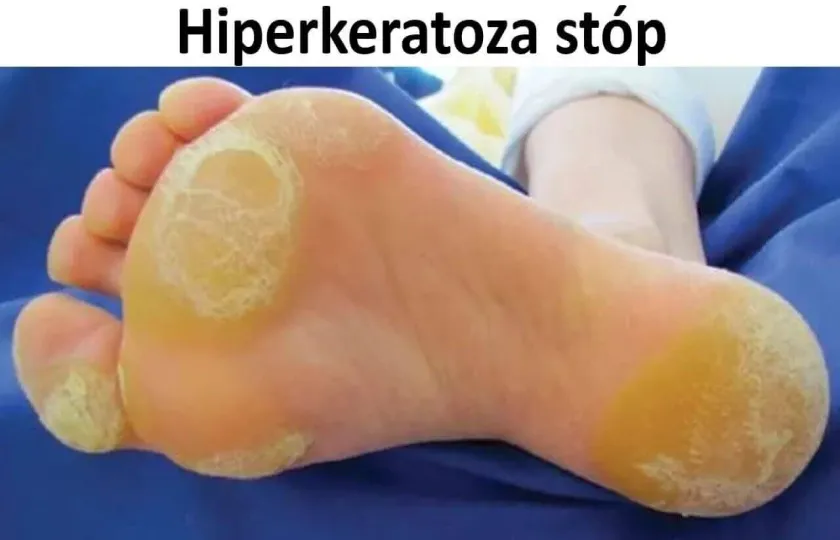 Hiperkeratoza stóp