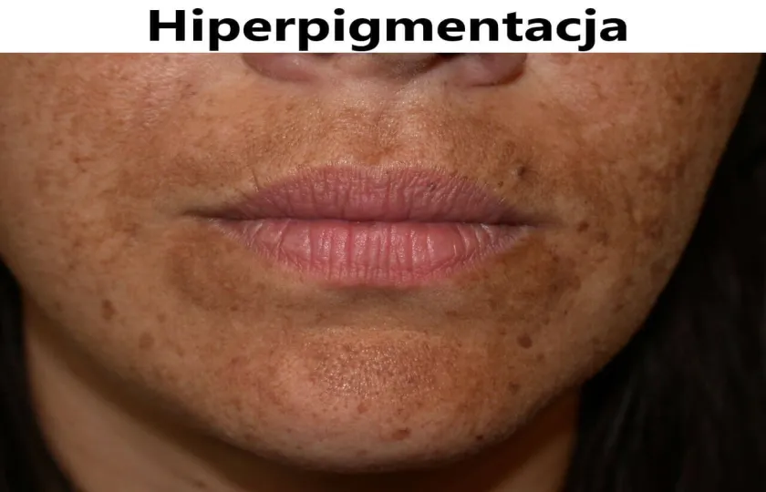 Hiperpigmentacja