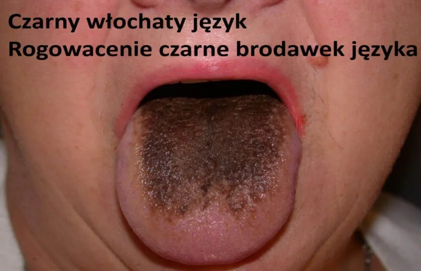 Czarny włochaty język, rogowacenie czarne brodawek języka