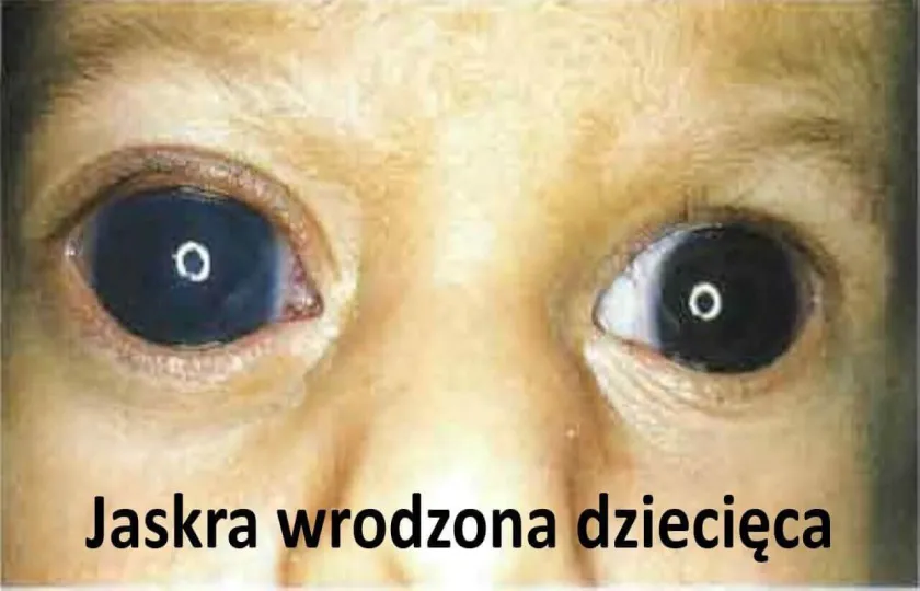 JASKRA WRODZONA U NIEMOWLAKA dziecka dziecięca 