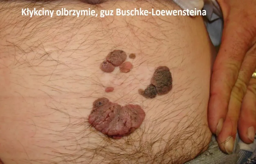 Kłykciny olbrzymie, guz Buschke-Loewensteina