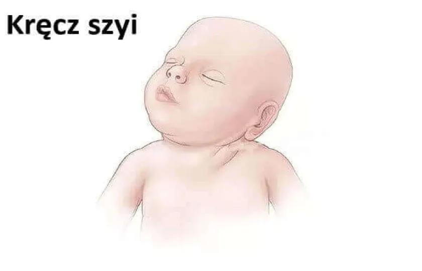 Kręcz szyi
