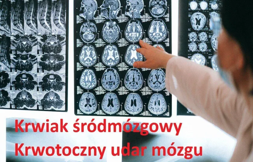 Krwiak śródmózgowy, krwotoczny udar mózgu 
