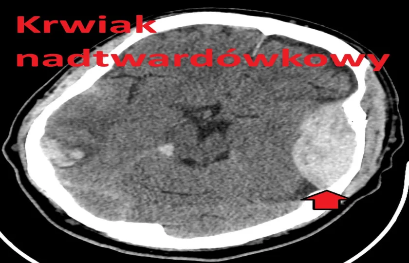Krwiak nadtwardówkowy 