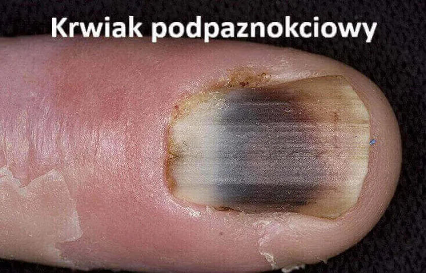 Krwiak podpaznokciowy 