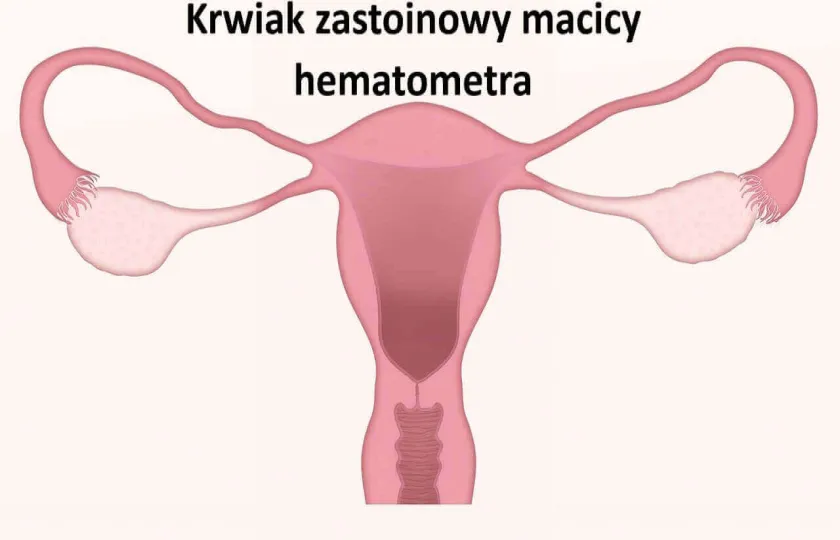 Krwiak zastoinowy macicy, hematometra