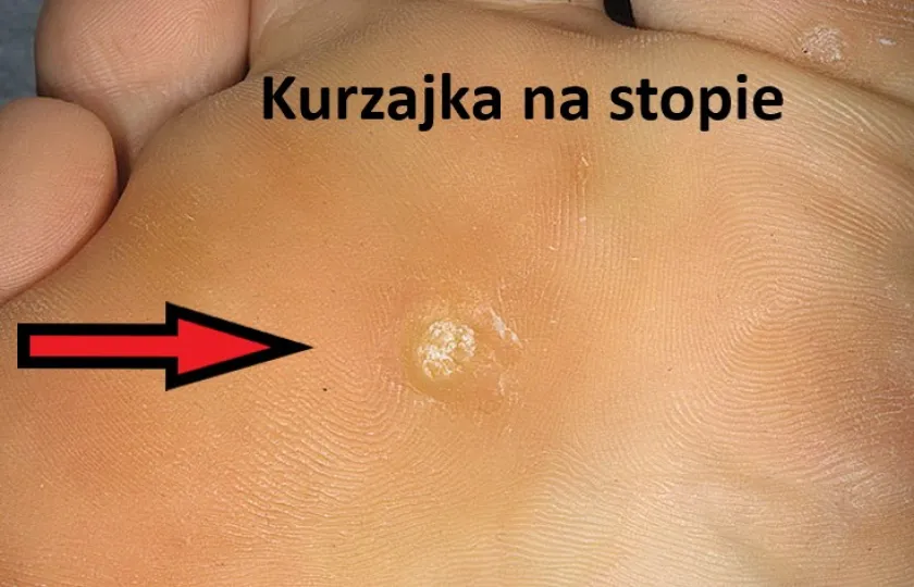 Kurzajka na stopie 