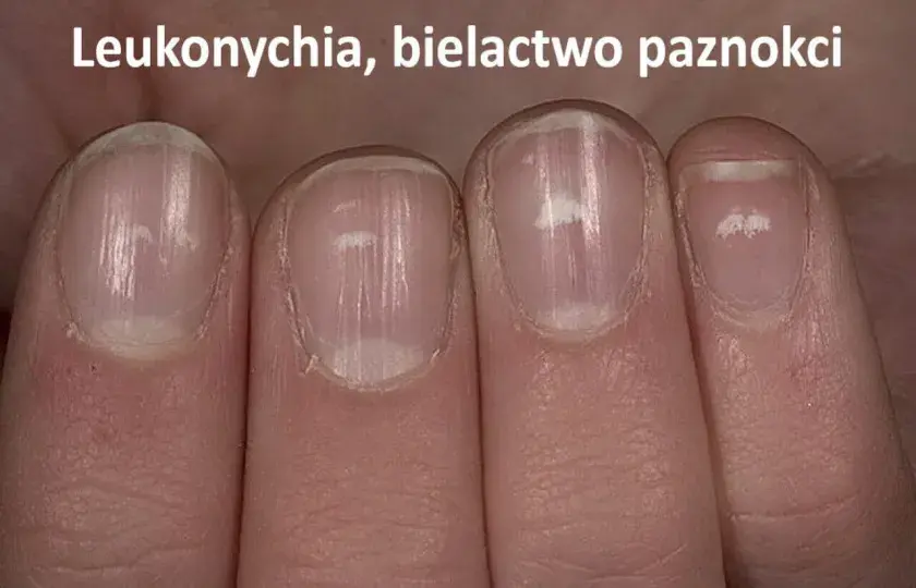Leukonychia, bielactwo paznokci, białe pazonkice