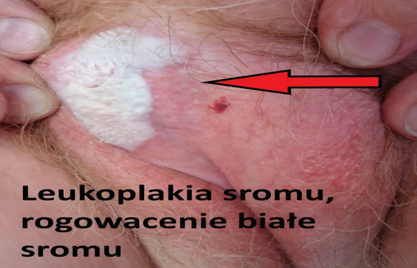 Leukoplakia sromu, rogowacenie białe sromu 
