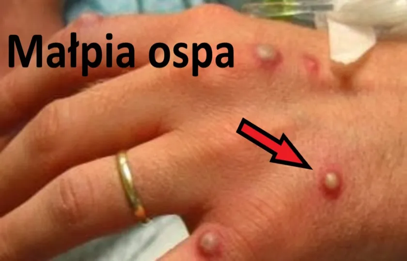 Małpia ospa 