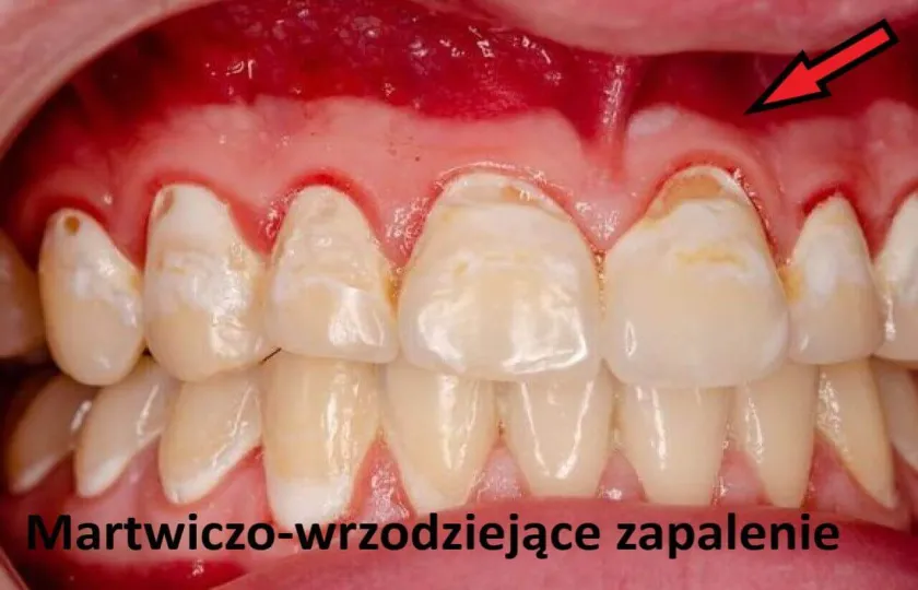 Martwiczo-wrzodziejące zapalenie dziąseł