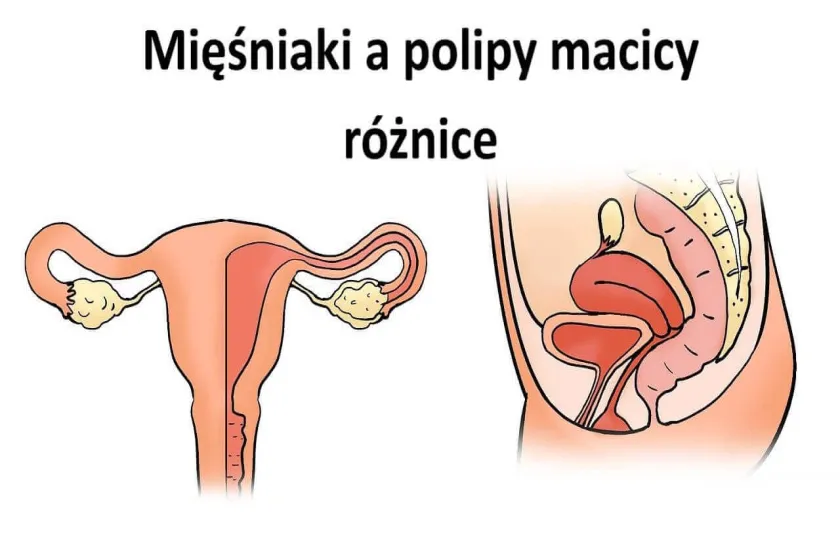 Mięśniaki a polipy macicy