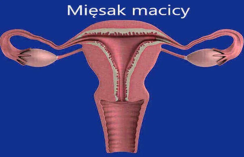Mięsak macicy 