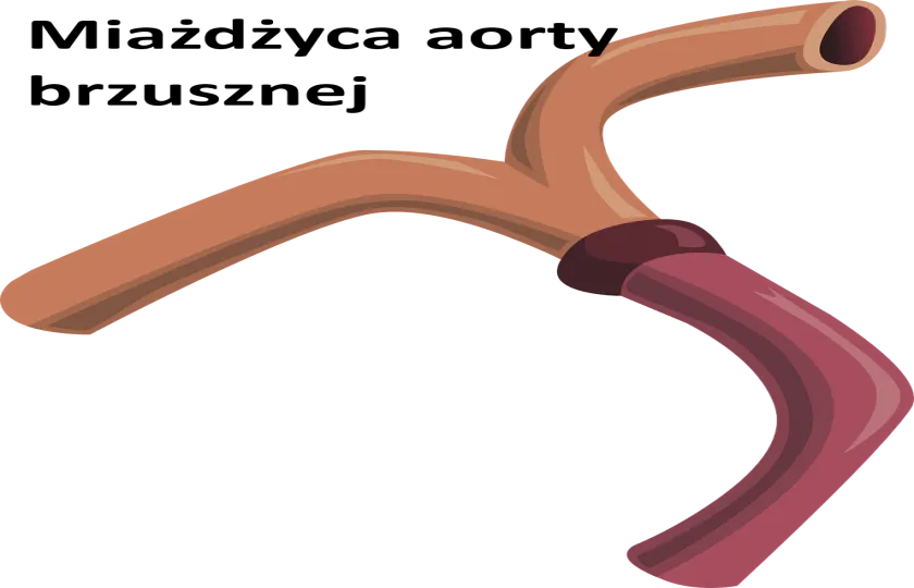 Miażdżyca aorty brzusznej 
