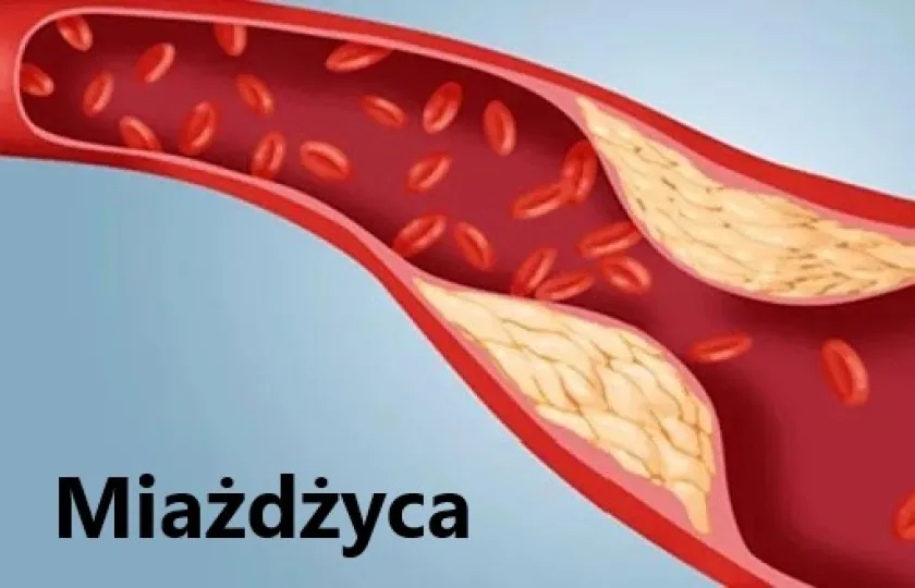 Miażdżyca 