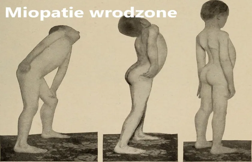 Miopatie wrodzone 