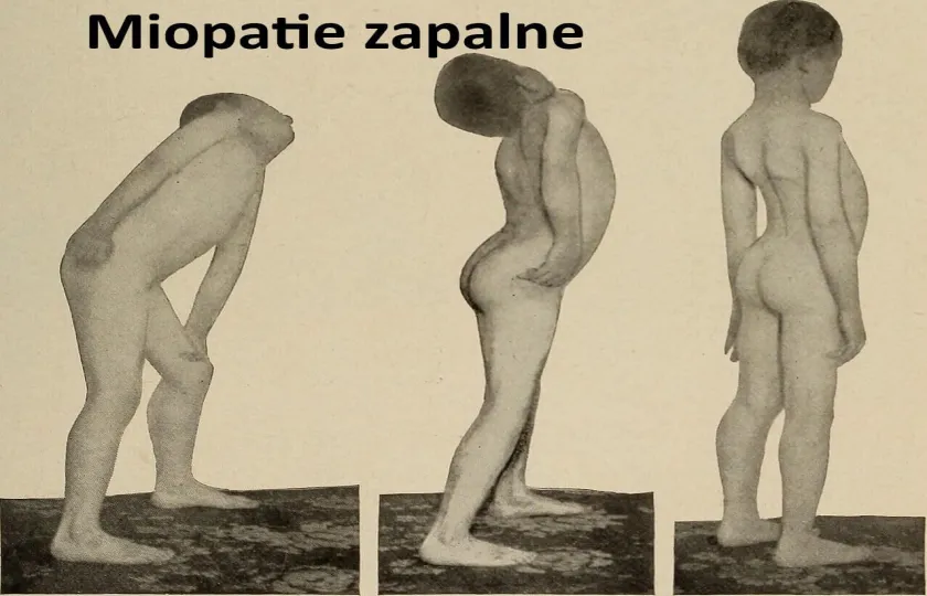  Miopatie zapalne 