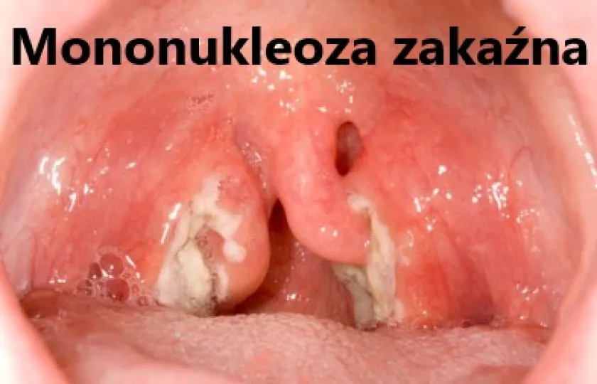 Mononukleoza zakaźna