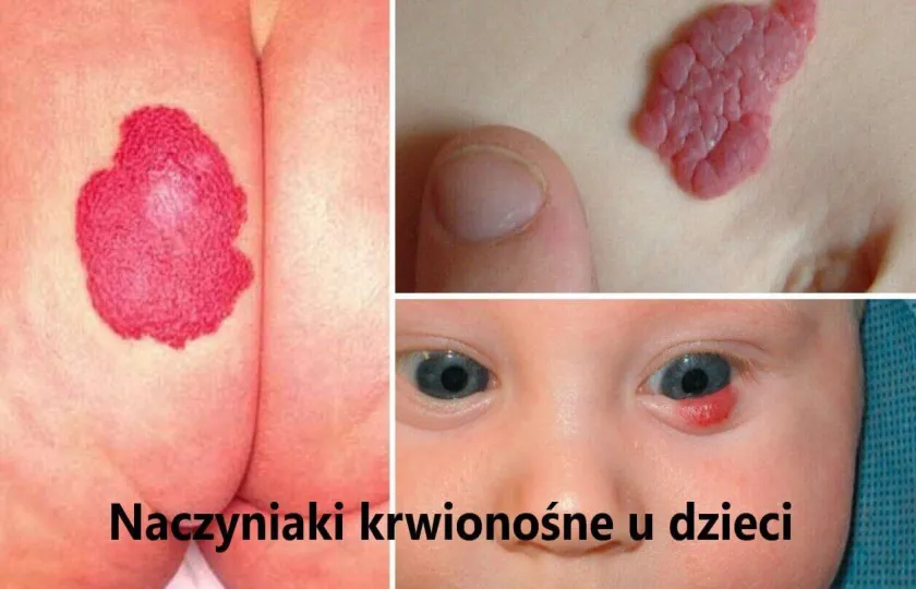 Naczyniaki krwionośne u dzieci zdjęcia, naczyniak u dziecka