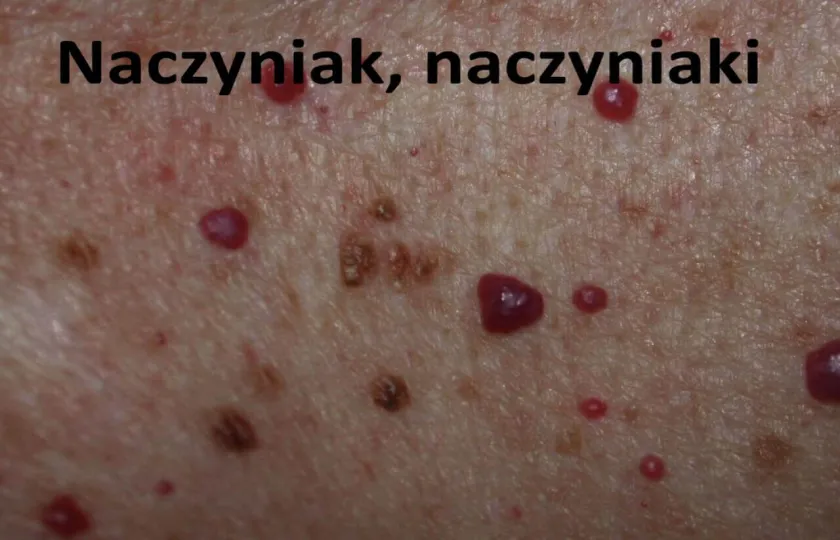 naczyniak, Naczyniaki 