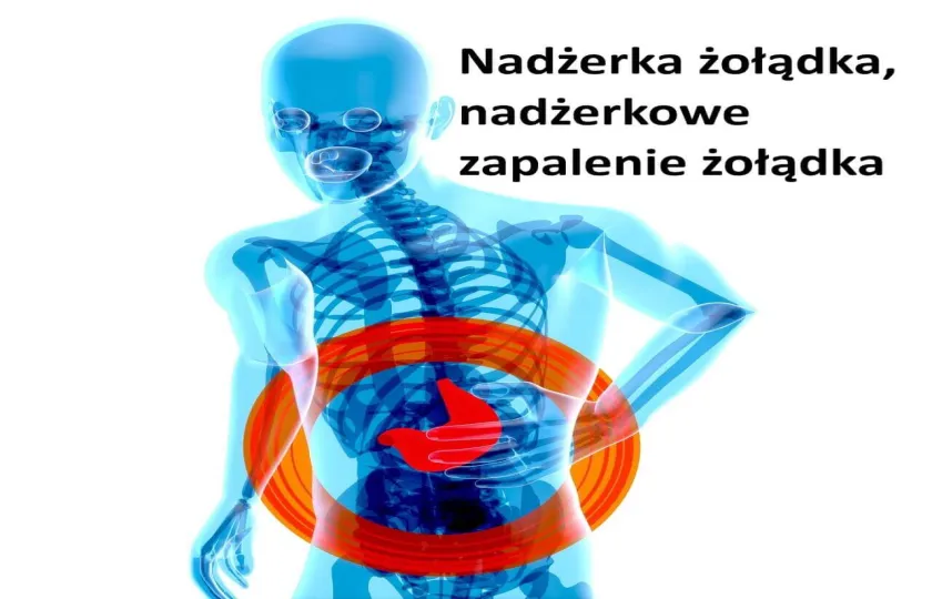 Nadżerka żołądka, nadżerkowe zapalenie żołądka