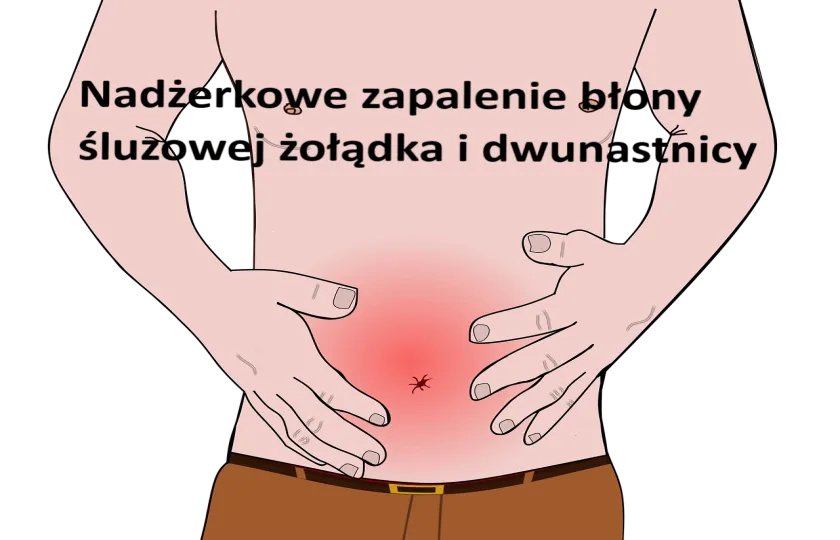 Nadżerkowe zapalenie błony śluzowej żołądka i dwunastnicy 
