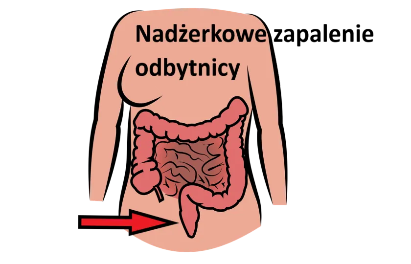 Nadżerkowe zapalenie odbytnicy, nadżerki błony śluzowej odbytnicy