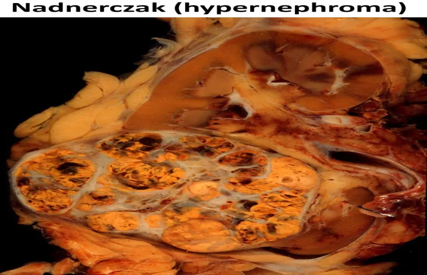 Nadnerczak, hypernephroma