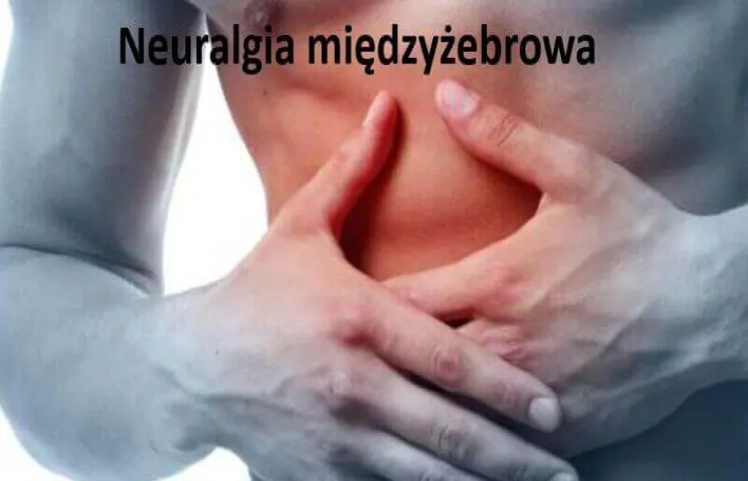 Neuralgia międzyżebrowa 