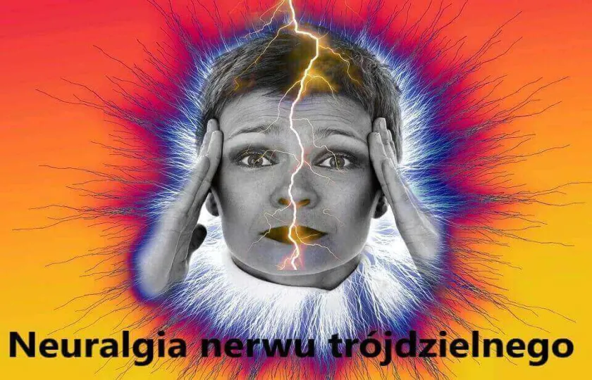 Neuralgia nerwu trójdzielnego