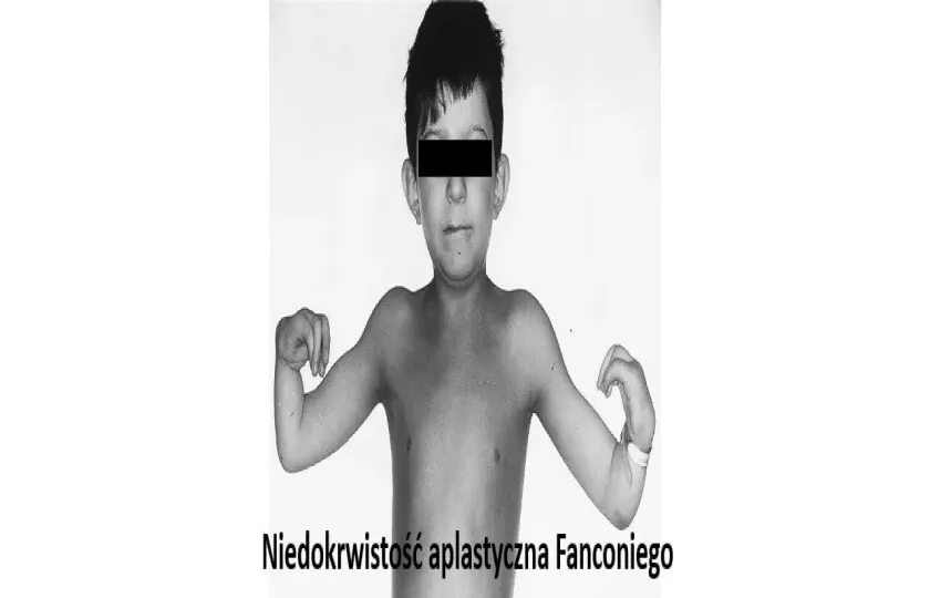 Niedokrwistość aplastyczna Fanconiego 