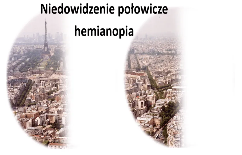Niedowidzenie połowicze, hemianopia