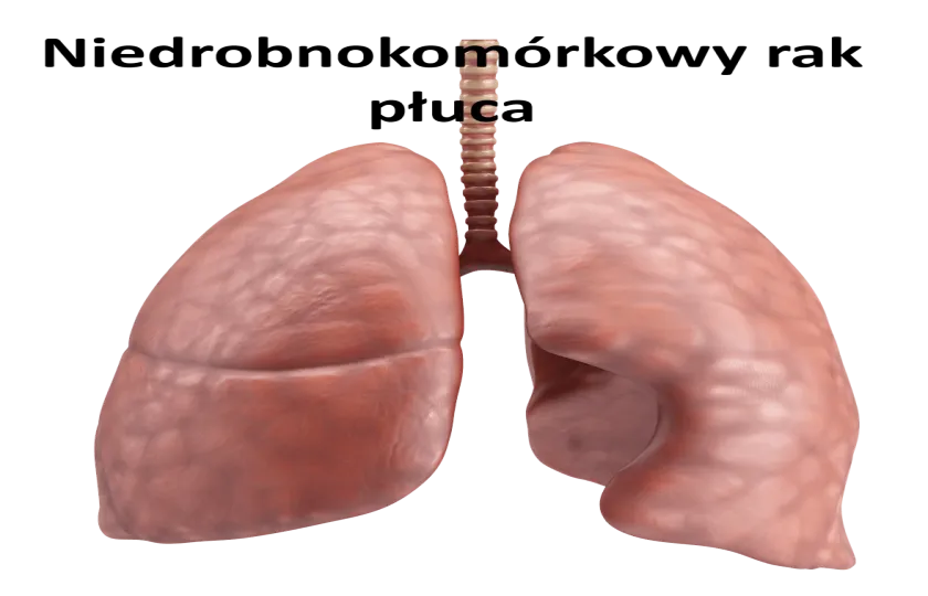 Niedrobnokomórkowy rak płuca 