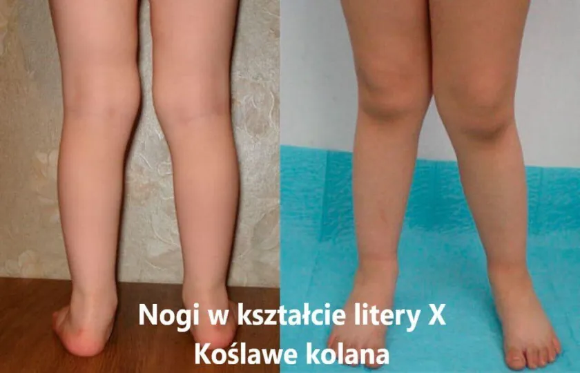Nogi w kształcie litery X, koślawe kolana, koślawość kolan