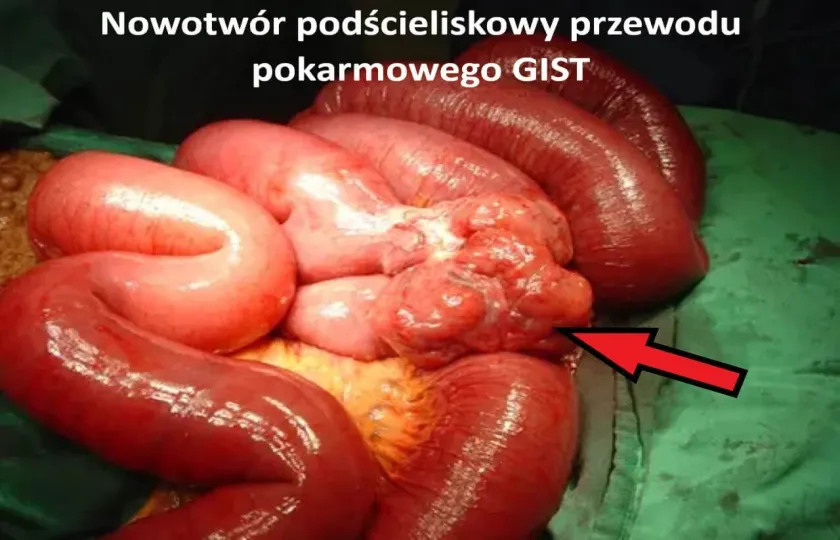 Nowotwór podścieliskowy przewodu pokarmowego GIST