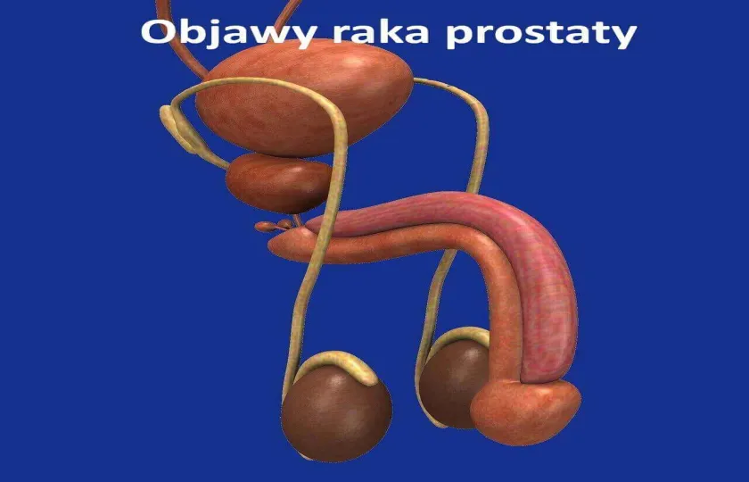 Objawy raka prostaty 