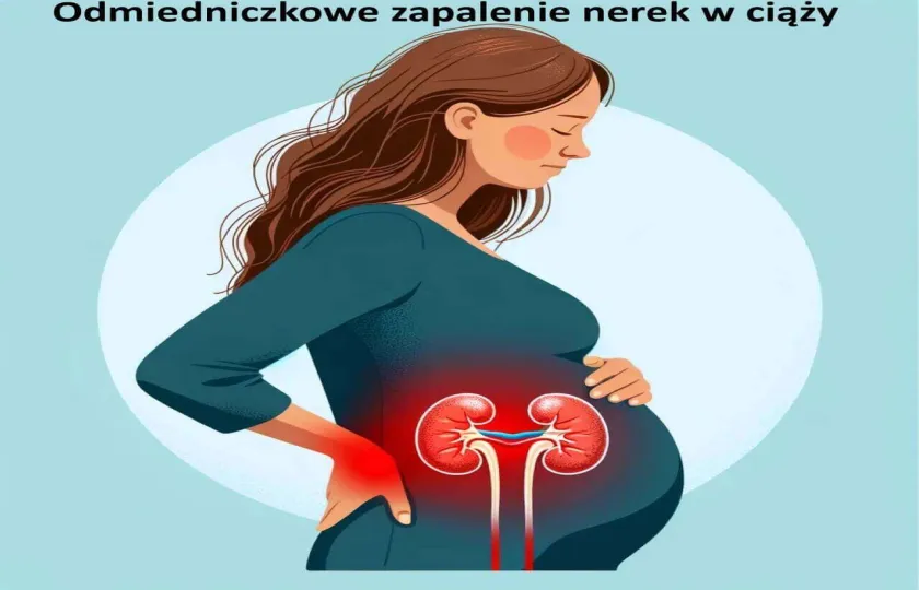 Odmiedniczkowe zapalenie nerek w ciąży, ciążowe odmiedniczkowe zapalenie nerek