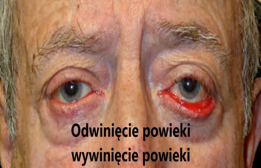 Odwinięcie powieki, wywinięcie powieki, ektropion