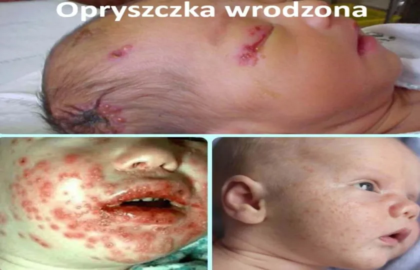 WRODZONE ZAKAŻENIE WIRUSEM OPRYSZCZKI, OPRYSZCZKA WRODZONA 