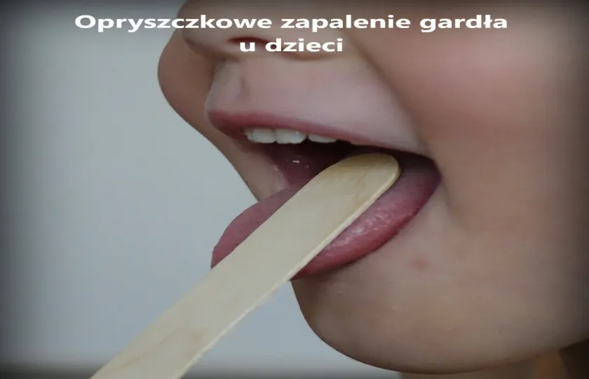 Opryszczkowe zapalenie gardła u dzieci 