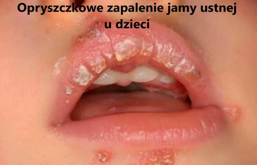 Opryszczkowe zapalenie jamy ustnej u dzieci