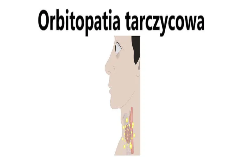 Orbitopatia tarczycowa 