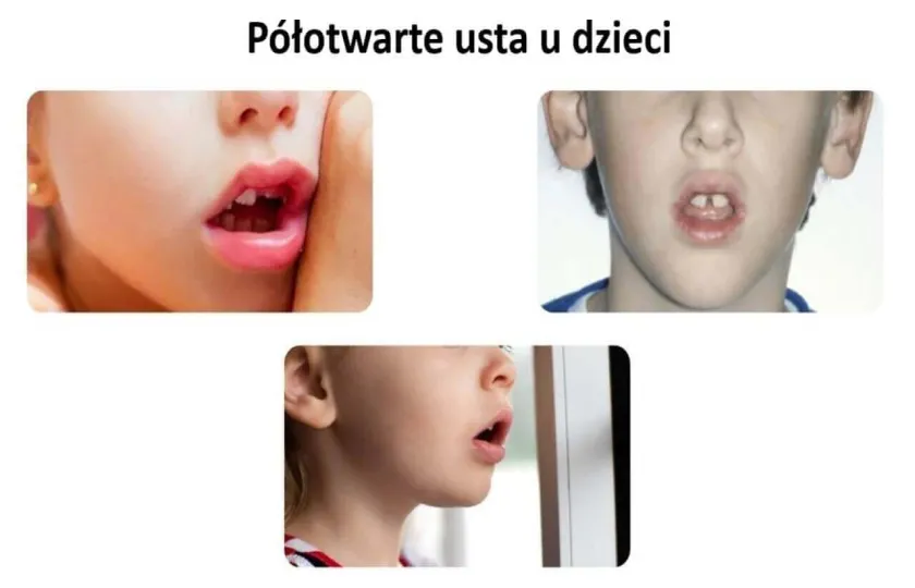 Półotwarte usta u dzieci, oddychanie przez półotwarte usta 