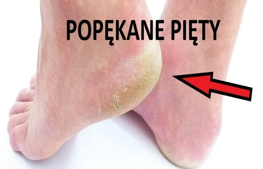popękane pięty przyczyny