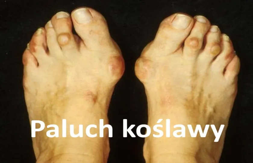  Paluch koślawy