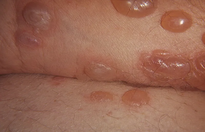 Pemfigoid pęcherzowy